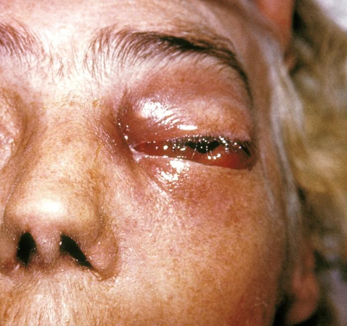 Periorbital fungal infection known as mucormycosis